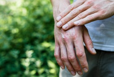 Tips for Managing Psoriasis Flare-ups